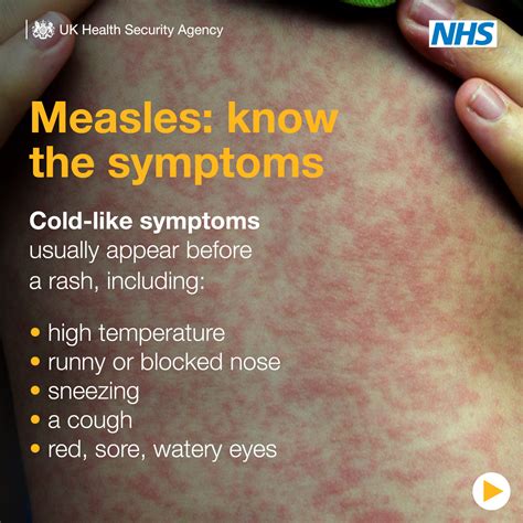 Measles - NHS Somerset ICB