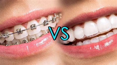 Invisible Braces or Traditional Ones? Orthodontist’s 2025 Guide