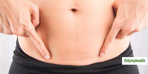 How To Get Rid Of Swollen Abdominal Muscles After C-Section?