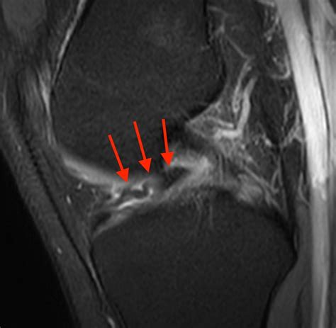 Bucket-handle Tear of the Meniscus - Radsource