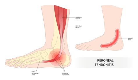 Peroneal Tendonitis Pain Location