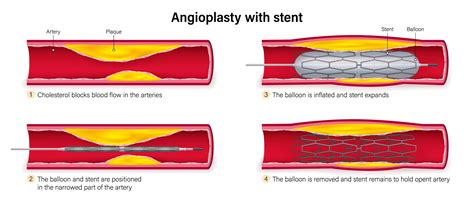 Balloon Angioplasty: Restoring Blood Flow Safely & Effectively