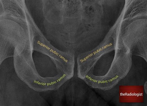 Pelvic X-Ray Guide – the Radiologist