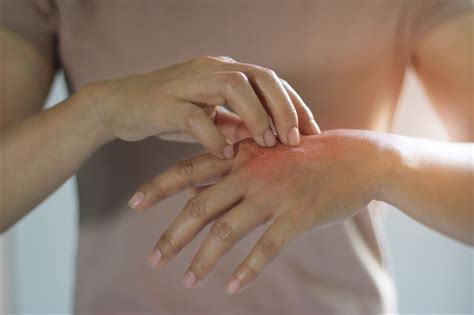 Eczema Stages: Acute, Subacute, and Chronic