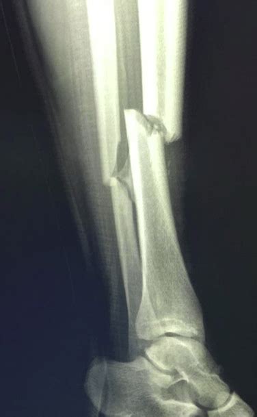 Fibula Fracture: Recovery Time (+Tips)