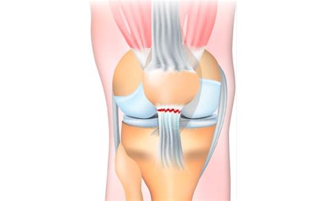 Patella Tendon Rupture | Kinvara Private Hospital