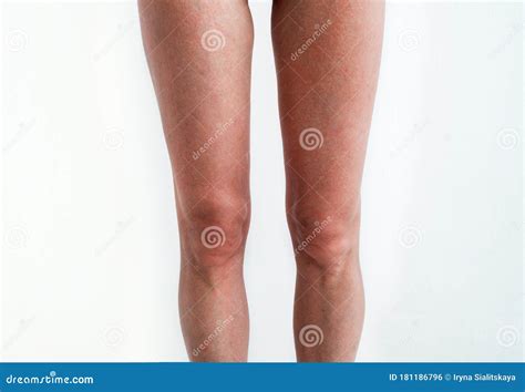 Severe Sunburn, Summer Tan, Poor Sun Protection. Sun Allergies, Obstruction, Itching Pain and ...