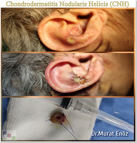Chronic Inflammatory Lesion in the Auricle: Chondrodermatitis Nodularis ...