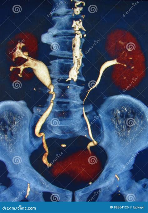 Image result for Urogram CT Scan
