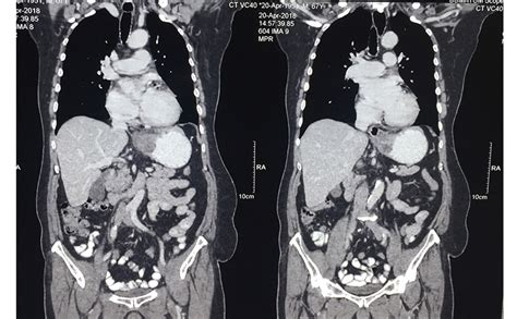 Stomach cancer / gastroesophageal junction - A Case history of 63 year ...