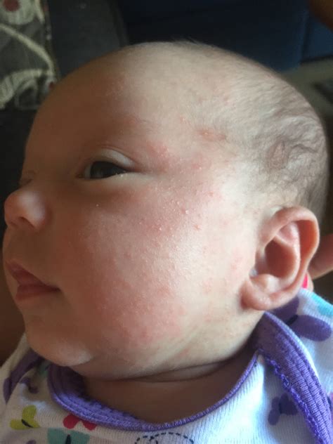 Baby Acne On Ears