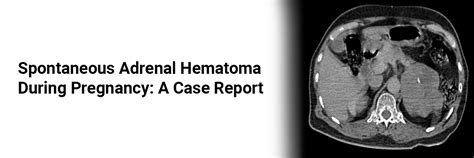 Spontaneous Adrenal Hematoma During Pregnancy: A Case Report