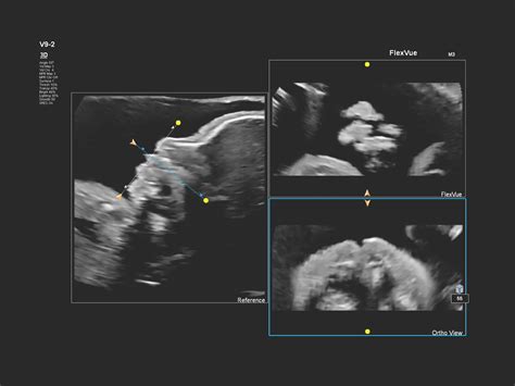 Seeing cleft: FlexVue with Orthogonal View - Philips