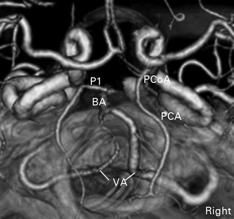 Anomalous vertebral and posterior communicating arteries as a risk factor in instrumentation of ...