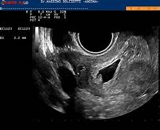 gestazionale senza embrione cause gestazionale senza embrione cause