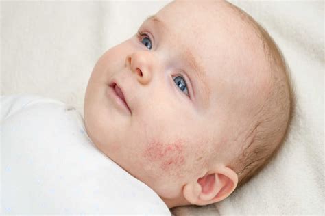 When should parents worry about their baby’s skin reactions?