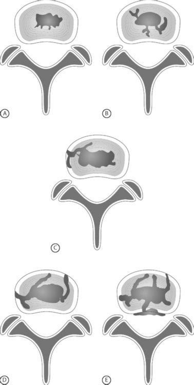 Image result for Lumbar Discogram