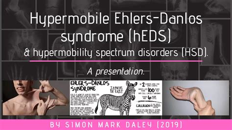 Hypermobile Ehlers-Danlos Syndrome & hypermobility spectrum disorders - A presentation | PDF