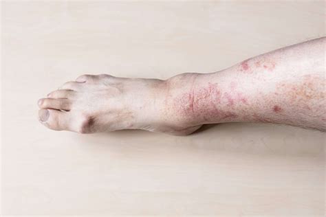 What Does Poison Ivy Look Like? How to Prevent and Heal Rashes Fast
