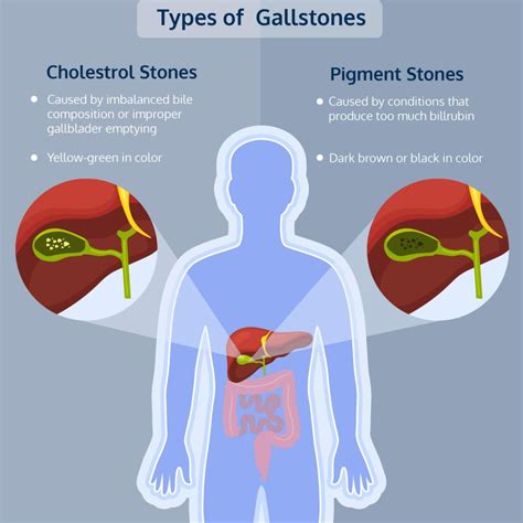 Are Gallstones Hereditary? - Decode with Xcode