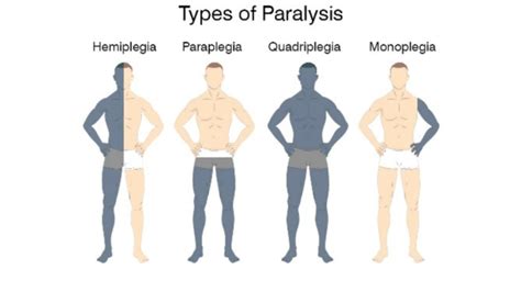 Paralysis 的图像结果