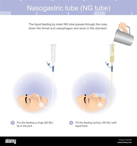 Nasogastric tube hi-res stock photography and images - Alamy