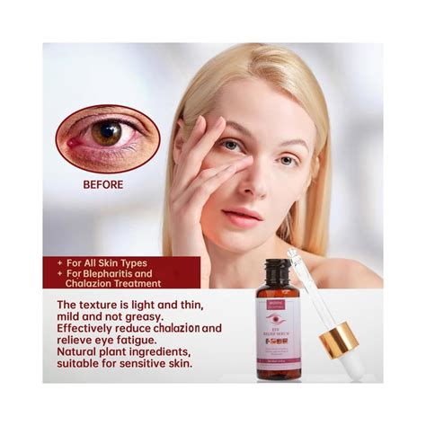 MIZEEYE Styes Eye Relief Serum, 30ml Moisturize Blepharitis India | Ubuy