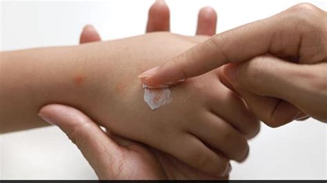 Insect Bites: कीड़ों के काटने से हो सकता है एलर्जिक रिएक्शन, जानिए कैसे ...