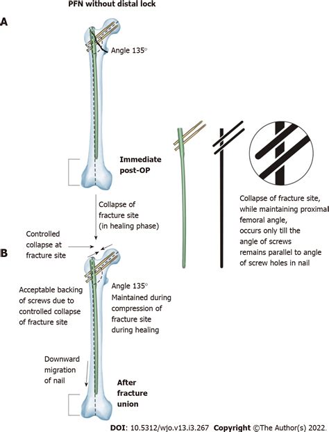 Short Proximal Femoral Nail