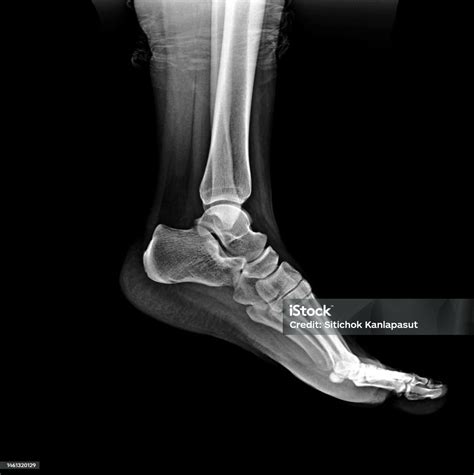 Normal Foot 的图像结果