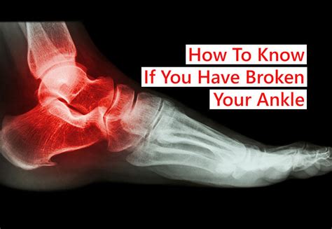 How to know if you have broken your ankle | Sports Injury Physio