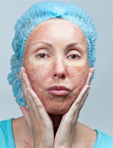 Facial Chemical Peels in Allen, TX | Face Peeling Treatments