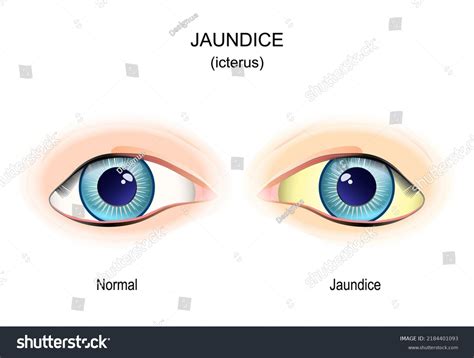 Jaundice Comparison Difference Normal Eye Eye Stock Vector (Royalty ...