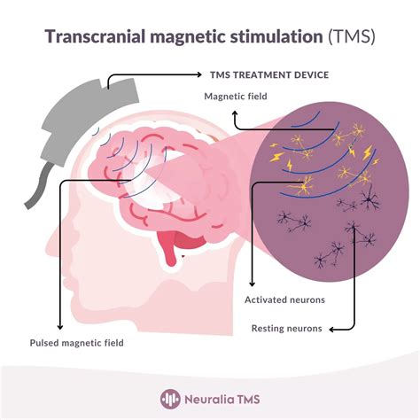 TMS Treatment for Depression in Perth | TMS Therapy Clinic