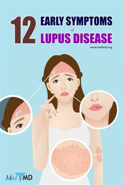 lupus in women