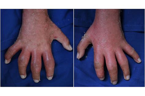 Arthritis In Knuckles Of Hand