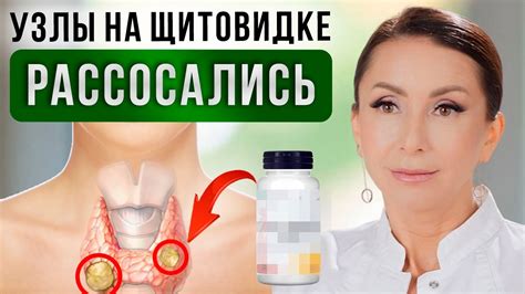 Как УМЕНЬШИТЬ УЗЛЫ щитовидной железы БЕЗ ОПЕРАЦИИ? Лечение щитовидной ...