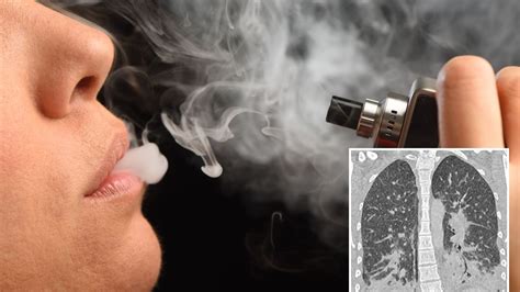 Woman, 19, left fighting for life after vaping leaves her lungs looking like 'shattered glass ...