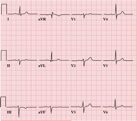Bundle Branch Blocks and Hemiblocks – EKG Essentials: A Student Handbook