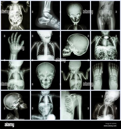 Infant x ray hi-res stock photography and images - Alamy