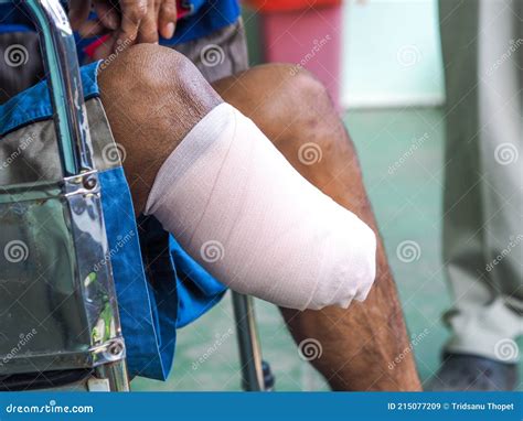 Elastic Bandaged Below Knee Amputation Stock Image - Image of disabled, amputated: 215077209