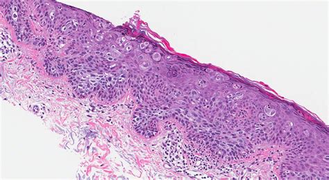 Squamous cell carcinoma in situ | MyPathologyReport