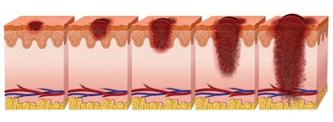 Melanoma Ulceration at Lauren Murphy blog