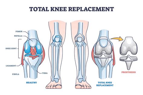 Types of Knee Replacement Surgery In The UK - The Best Of Health