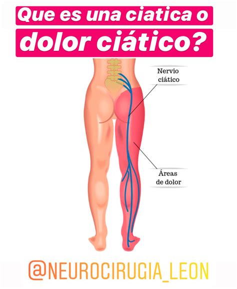Dolor En Ciatica