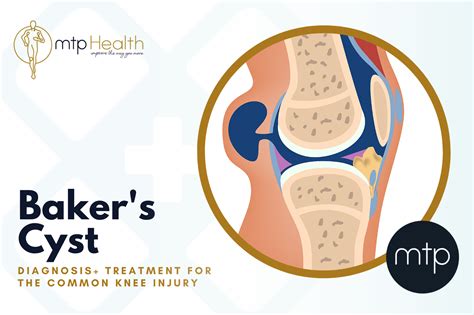 What is a Baker’s Cyst? How its diagnosed and treated. - MTP Health