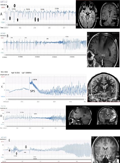 Temporal lobe epilepsy page: Role of temporal lobe structures and subjacent pathology in the ...