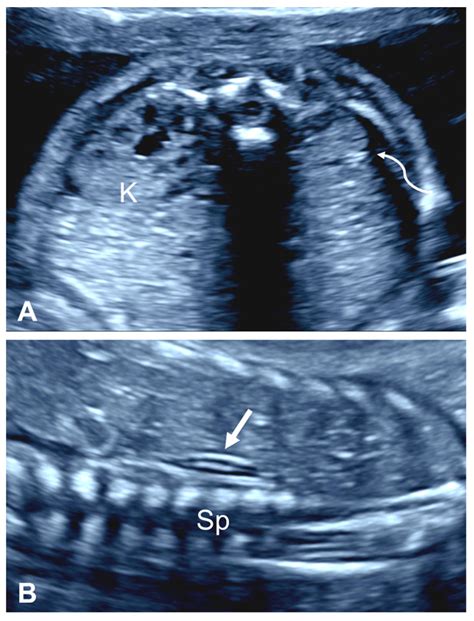 Unilateral Renal Agenesis: Prenatal Diagnosis and Postnatal Issues