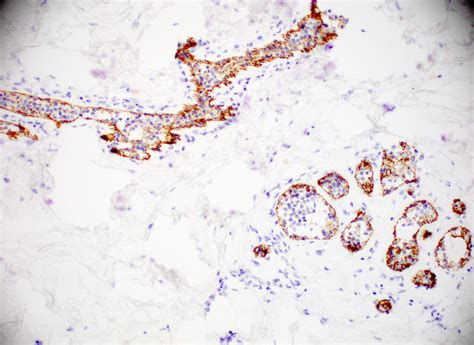 Pathology Outlines - Atypical lobular hyperplasia