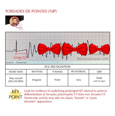 Torsades de Pointes (TdP) on the ECG for nurses & nursing students — The Visual Nurse